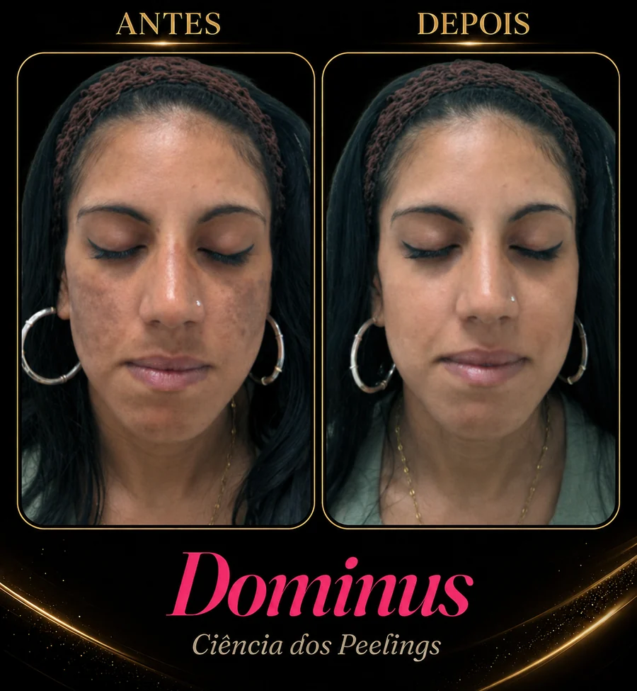 Resultado Dominus — antes e depois de melasma (caso 2)
