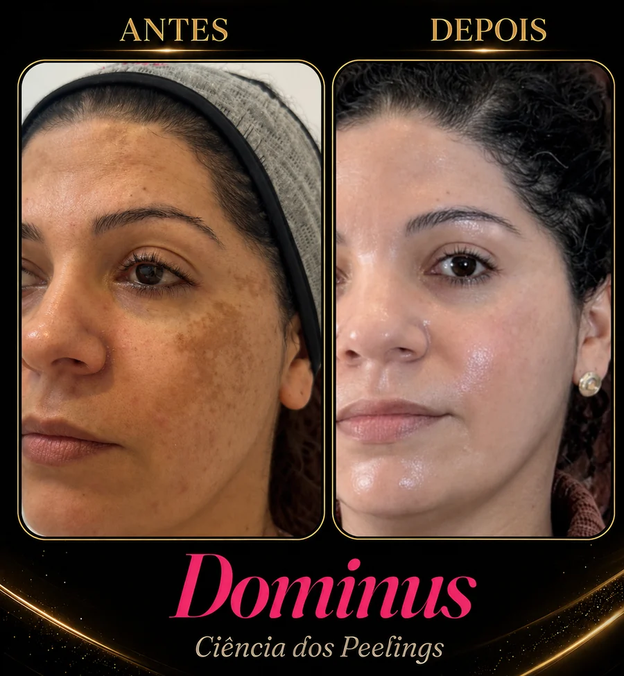 Resultado Dominus — antes e depois de melasma (caso 3)